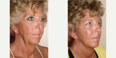 55-64 year old woman treated with Facelift, Neck Lift - This patient underwent facelift and necklift.