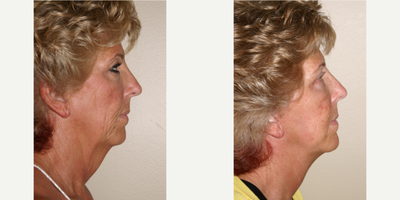 55-64 year old woman treated with Facelift, Neck Lift - This patient underwent facelift and necklift.