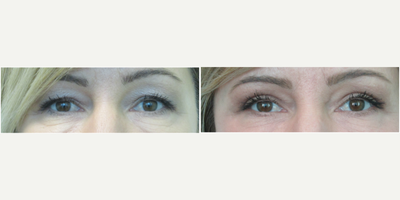 45-54 year old woman treated with Upper Eyelid Surgery/Blepharoplasty - This middle aged woman presented with the concerns of heavy and hooded eyelids. She liked the height of her eyebrows, but preferred to have less skin over her lids since they made her feel tired and made make-up application more difficult. We decided to proceed with an upper blepharoplasty treatment. Under local anesthesia in our Center, we performed the procedure in under one hour. The after photo demonstrates increased show of her upper lids along with better balance (note: her right eye was previously more hooded than the left). She stated that make-up application was easier and that her eyes also looked better without make-up. She was able to return to normal activities 5 full days after the procedure.