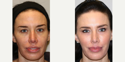 Woman treated with Cheek Augmentation - Woman treated with Cheek Augmentation through Facial Fat Transfer. The fat pockets were contoured and took some fat from the abdomen to place into the tear troughs and face. She also had transconjunctival lower eyelid blepharoplasty and laser resurfacing.