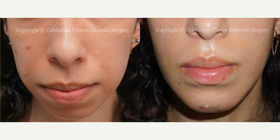 Woman treated with Chin Implant, Chin Filler - This patient had Chin Augmentation with an Implant (2 weeks post-operation).