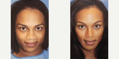 Woman treated with Genioplasty - Woman treated with Genioplasty