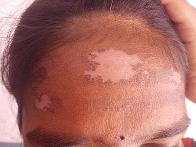 Recovery Time Of IPL Burns On My Forehead . Doctor Answers, Tips