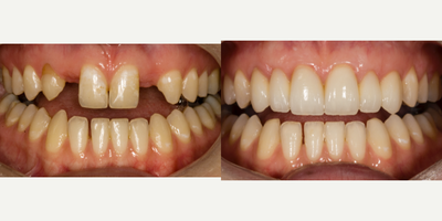 25-34 year old woman treated with Smile Makeover - Patient was congenitally missing lateral incisors and her roots were too close to place implants. Conservative e.max ceramic bridges were placed with ovate pontic sites to simulate a tooth growing from the gum tissue so it will look realistic. One 3 unit bridge went from right canine to right central incisor and the other one went from left central incisor to left canine. The match was made to the lower front teeth by the master ceramist.