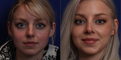 25-34 year old woman treated with Rhinoplasty - primary rhinoplasty