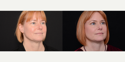 Woman treated with Neck Lift - Woman treated with Neck Lift