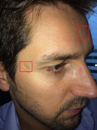 Depressedindented Scars On The Forehead Any Suggestions Photos