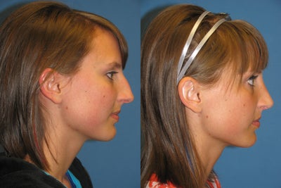 Rhinoplasty -
Cosmetic endonasal septorhinoplasty. Patient was concerned about a prominent dorsal hump and a wide tip. Closed approach with tip delivery and suturing, collumalar strut graft placed.