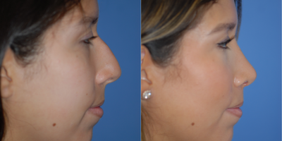 18-24 year old woman treated with Rhinoplasty - Nice rhinoplasty result with a straighter nose, no bump, and refined tip.