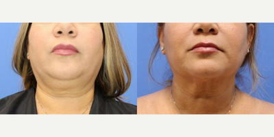 Chin Liposuction - Procedure: Submental liposuction with NecktitePurpose: Remove excess fat of the submental region to create a more visible jawlinePatient goal: Patient wanted to have a more defined and prominent jawlineRecovery: Mild discomfort and minimal bruising for the first week. Final result between 1-3 months. Photo taken at 1 month post-op. This patient will continue to see results of the neck tight for the next few months!This procedure can be done under local anesthesia as well as be paired with other procedures done under general anesthesia
