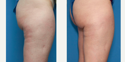 47 year old woman treated with Aveli - Cellulite dimples on buttocks and creases on thighs treated with Aveli.