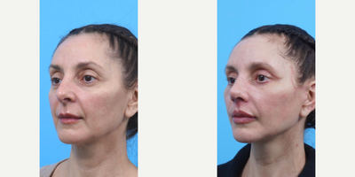 Woman treated with Eyelid Surgery, Facelift, Neck Lift, Lip Lift, Lip Implants, Rhinoplasty - Woman treated with Eyelid Surgery, Facelift, Neck Lift, Lip Lift, Lip Implants, Rhinoplasty
