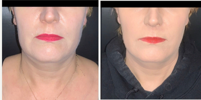 35-44 year old woman treated with Ultherapy - 8 weeks following a single Ultherapy session! Results will continue to enhance up to 6-12 months.