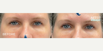 Woman treated with Restylane - Woman treated with Restylane