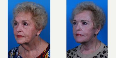 65-74 year old woman treated with Facelift, Eyelid Surgery, Laser Resurfacing - Dr. Becker performed a Facelift, Contour Full Face TRL Laser Resurfacing, Blepharoplasty Transconjunctival with Fat Repositioning, and Bilateral Upper Blepharoplasty.