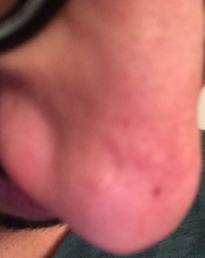 I have had these bumps on nose and I am sure they are acne I have had these bumps on nose and I am sure they are acne