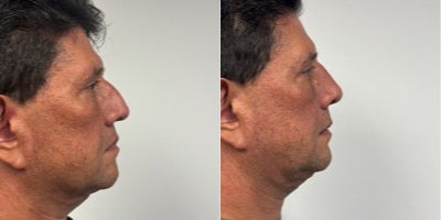 45-54 year old man treated with Rhinoplasty - 3 weeks after a Rhinoplasty