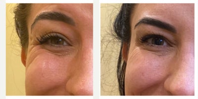 35-44 year old woman treated with Dysport - 37 year old expressive woman before and after Dysport injections to the classic 3 muscles of the face:  11 lines, forehead and crow's feet.More symmetric, arched brows, rested face and open-eyed smile....and of course future wrinkle prevention!