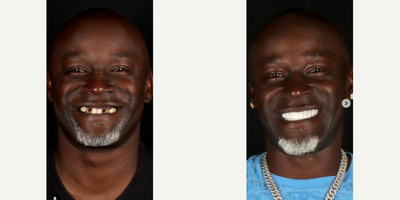 Man treated with Porcelain Veneers - Man treated with Smile Makeover, Porcelain Veneers