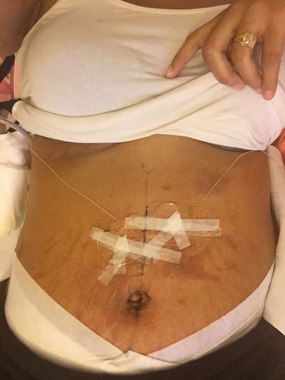 Rash build up after surgery. Will the marks go away ...