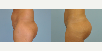 25-34 year old woman treated with Butt Augmentation - This 28 year old was treated with Butt Augmentation through autologous fat transfer harvested by Vaser liposelection of her abdomen, flanks, and thighs.