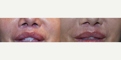 Los Angeles Fractional Resurfacing for Lip Lift Scar Removal - Patient had as lip lift scar and had surgical scarring in the skin and cartilage under the nose.  This is after one combination Sciton MicroLaser and fractional resurfacing procedure.  This is not Fraxel, but Profractional resurfacing and works better than radiofrequency, microneedling and other forms of scar removal.  Typically in 1-2 visits.Lip lift surgeries are gaining popularity and as they do, we are seeing the post surgery scars more often.  If you have a surgical scar that you'd like to improve, give us a call today.