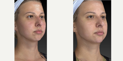 25-34 year old woman treated with Restylane Lyft - This young pretty girl came in for some chin and jawline sculpting. Dr. Caughlin is becoming known for these procedures. Pay attention to the angle of the jaw and chin projection.