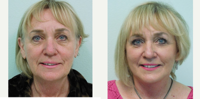 60+ year old woman treated with Fat Transfer - This active woman wished for rejuvenation of her drooping midface and unhealthy appearance. Together we agreed on fat grafting/transfer to the midface (cheeks and eye hollows) along with a jawline lift and fractional laser treatment of her lower eyelids. Her appearance is a significantly natural rejuvenation which restored her youthful glow.