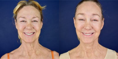 65-74 year old woman treated with Deep Plane Facelift, Neck Lift, Brow Lift, Eyelid Surgery, Lip Lift, Facial Fat Transfer, Cant - This female patient had a previous upper and lower eyelid surgery and forehead lift 10 years ago. She had a wrinkle neck, fallen cheeks, jowls and dropping jawline, she has a very active platysma bands and tired expression. Her eye brow position droops. Dr. Valdez performed a Deep lip lift, Deep Plane Facelift and Necklift, Platysmoplasty, lower and upper blepharoplasty, cnathoplasty, endoscopic browlift and forehead lift and micro and nano facial fat grafting. Now she has 5 months after her surgery.