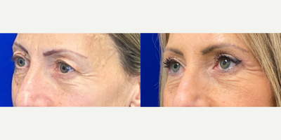 55-64 year old woman treated with Eyelid Surgery - 57 years old 3 months after Upper blepharoplasty and CO2 laser.