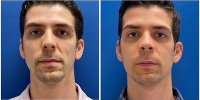 32 year old man treated with Jaw Surgery - 32 year old man treated with Jaw Surgery.f