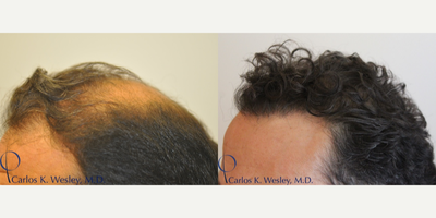 45-54 year old man treated with Hair Transplant - FUT procedure