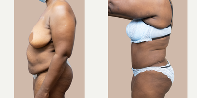 45-54 year old woman treated with Tummy Tuck - Patient underwent tummy tuck. She is shown here 3 months post-op.