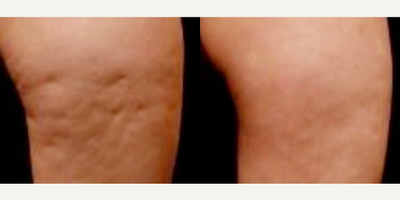 Woman treated with Aveli - Thigh cellulite is gone after just one treatment of Aveli! Aveli is the first and only device that allows the to identify each cellulite dimple, then release each septa, and verify the dimple is completely released resulting in a smooth skin surface.