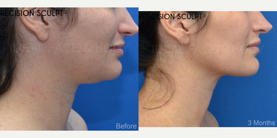 35 year old woman before and after advanced liposculpting of the chin, neck, and jawline. - This is a lovely female who wished for a more defined jawline, no double chin, and a snatched neck. We performed a specialized liposculpting procedure PRECISION SCULPT. This advanced surgery is performed under complete local anesthesia with the option of comfortable relaxation using oral medications. Tiny hidden incisions are used to evenly and smoothly remove all of the excess fat throughout the front of the neck from the chin to the angles of the jaw and down to the front of the lower neck. Laser and radiofrequency are delivered to the tissue to promote tightening. This procedure takes about 45 minutes. Patients typically return to work in a few days.