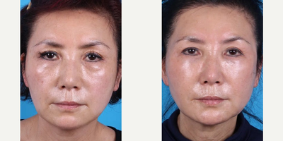 65 year old woman treated with Bellafill - Bellafill, 65y