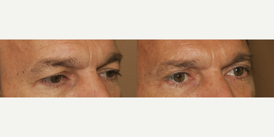 Man treated with Eyelid Surgery - Man treated with Eyelid Surgery