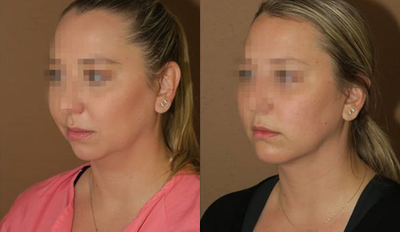 Woman treated with Laser Liposuction - Woman treated with Laser Liposuction of the neck