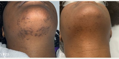 45-54 year old woman treated with Laser Hair Removal - This patient underwent her first laser hair removal session to address dense, hormonally-driven hair growth along the chin.In her before photos, you can clearly see coarse, dark hairs and areas of inflammation and hyperpigmentation commonly associated with hormonal hair cycles. After just one treatment, there is a visible reduction in active hair follicles, a smoother skin surface, and less irritation in the treated area.Laser hair removal is especially effective for patients experiencing hormonal chin hair, helping to thin and reduce regrowth over time while minimizing razor bumps, ingrown hairs, and chronic inflammation.