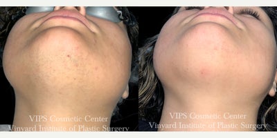 25-34 year old woman treated with Laser Hair Removal - This patient experienced a noticeable reduction in coarse, hormonally-driven chin hair after just one laser hair removal session. In the after photo, you can see fewer dark terminal hairs, less shadowing under the skin, and a smoother, more even appearance along the chin and jawline. Early improvements like these are common in patients with hormonal hair growth, and results continue to refine with a full treatment series.