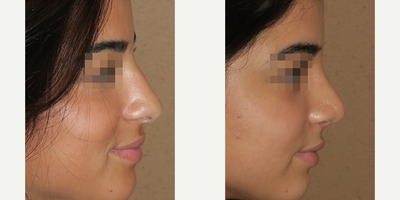 Woman treated with Rhinoplasty - Woman treated with Rhinoplasty- 2 months post-op
