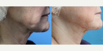 65-74 year old woman treated with Skin Tightening - 70 year old woman looking to improve her lower face and neck's appearance. The doctor used Profound which is radio frequency microneedling to achieve this result.