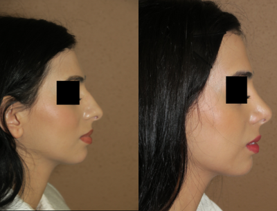 25-34 year old woman treated with Rhinoplasty - rhinoplasty