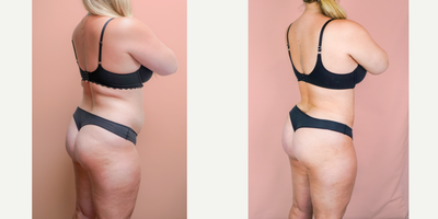 25-34 year old woman treated with Brazilian Butt Lift, Liposuction - This lovely patient requested a Brazilian Butt Lift and 360 Lipo to improve her shape, contour and buttock/hip projection. She is shown 2 months post-op and is loving her new body with extra confidence.