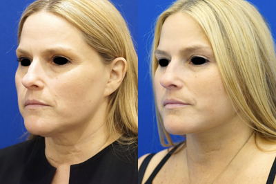 45-54 year old woman treated with Deep Plane Facelift - Nothing targets and treats loose skin of the lower face and neck better than a deep plane lower facelift and platysmaplasty. The skin of the lower face and neck is never over-pulled and results are long-lasting.