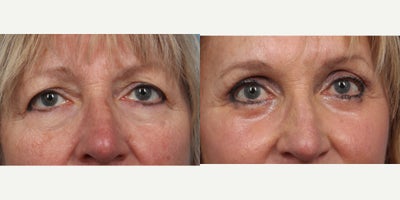 55-64 year old woman treated with Brow Lift, Eyelid Surgery, Laser Resurfacing - 3 months post op