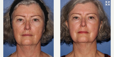 65-74 year old woman treated with Scar Removal, Laser Scar Removal - Full face laser resurfacing