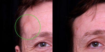 35-44 year old man treated with Lipoma Removal - Lipoma removal via surgical excision. Lipomas are benign fatty lumps under the skin. Complete removal with minimal scarring.