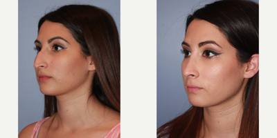 25-34 year old woman treated with Rhinoplasty - Rhinoplasty