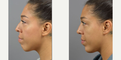 Woman treated with Nonsurgical Nose Job, Botox, Dermal Fillers - Facial Asymmetry and contour is natural and makes each face unique. While most imperfections go unnoticed by the outside world. Often times we treat with surgical interventions but for a temporary adjustment with just as much impact the use of Botox and Filler can be used. Non-surgical Rhinoplasty by Dr. James Marotta complimented by filler injections to the chin.